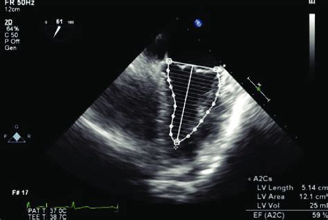 ejection fraction 50 55.